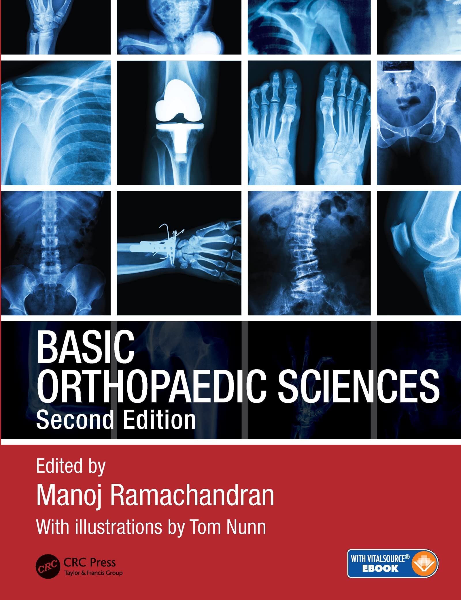 Basic Orthopaedic Sciences, The Stanmore Guide, 2Nd Edition