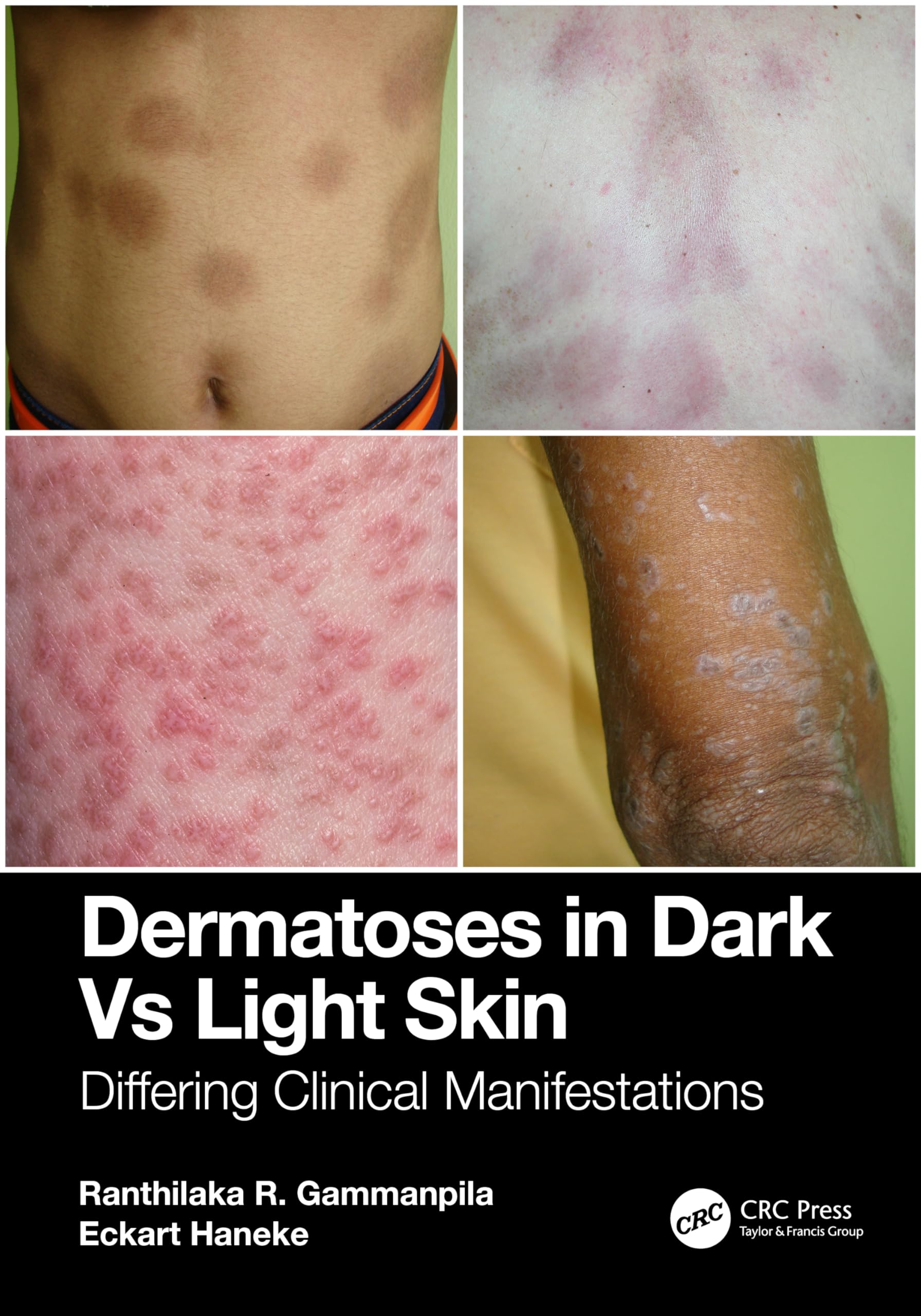 DERMATOSES IN DARK VS LIGHT SKIN DIFFERING CLINICAL MANIFESTATIONS (PB 2025)