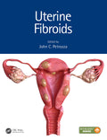 Uterine Fibroids (Hb 2021) (Reproductive Medicine And Assisted Reproductive Techniques)