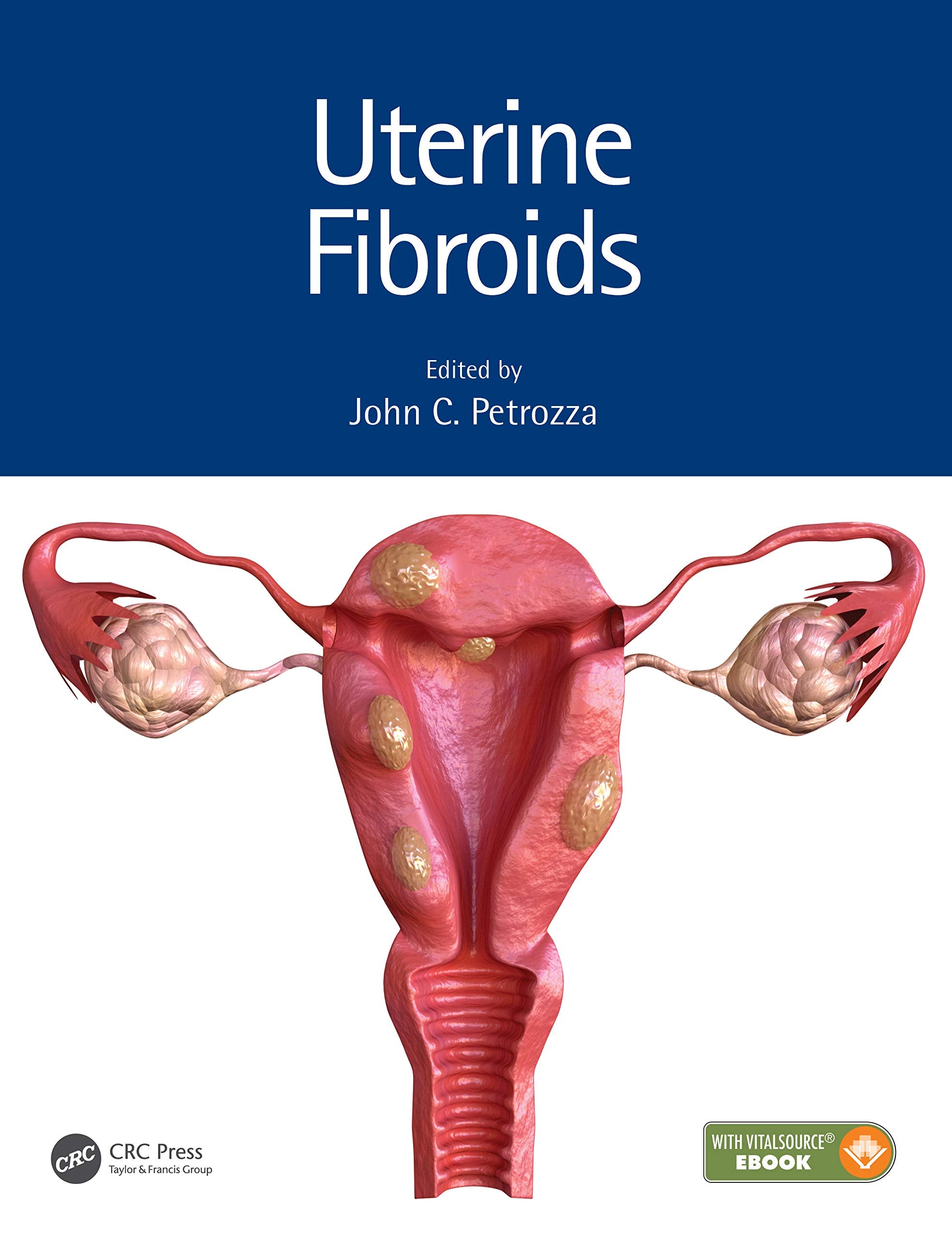 Uterine Fibroids (Hb 2021) (Reproductive Medicine And Assisted Reproductive Techniques)