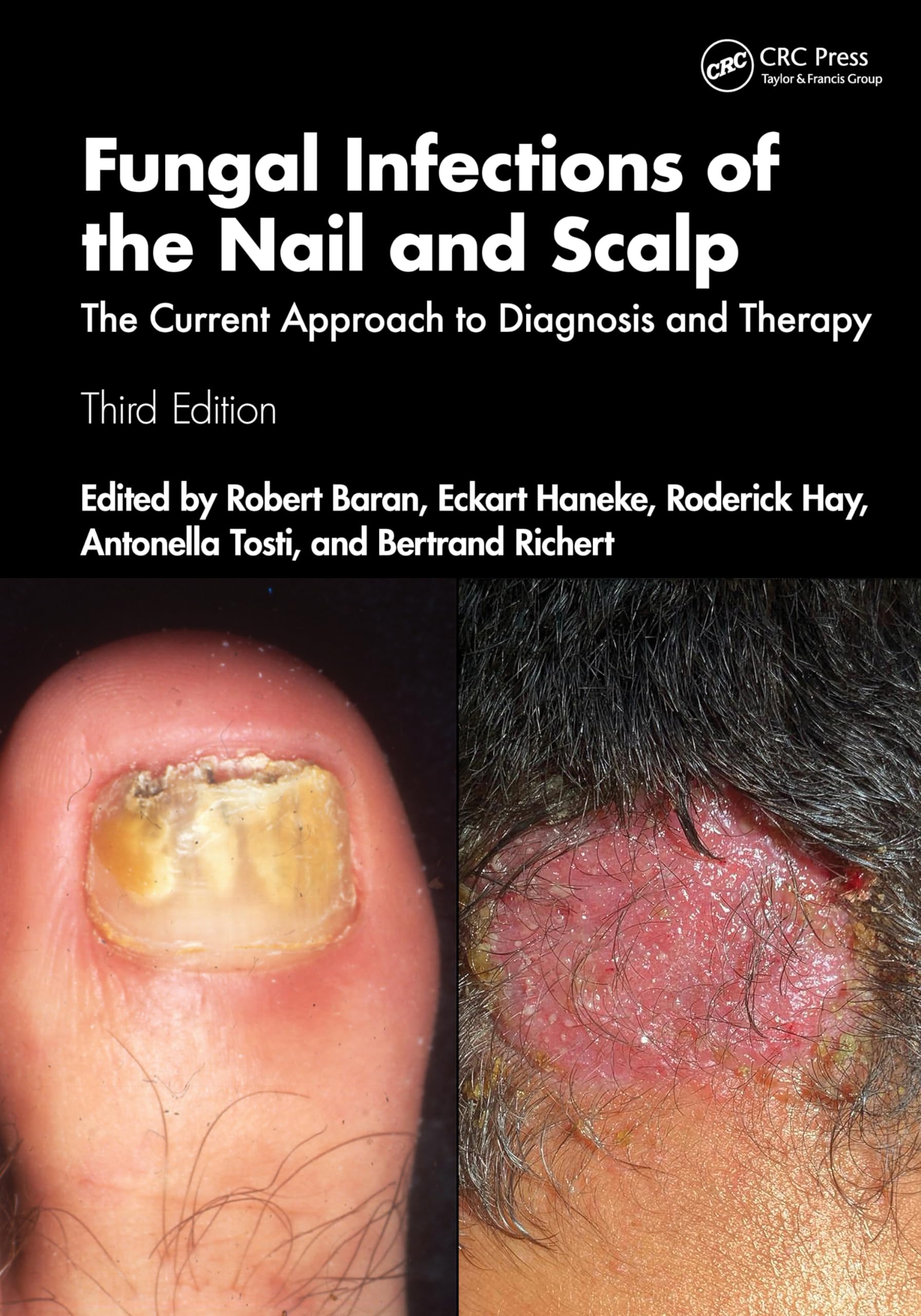 Fungal Infections Of The Nail And Scalp The Current Approach To Diagnosis And Therapy 3Ed (Pb 2025)