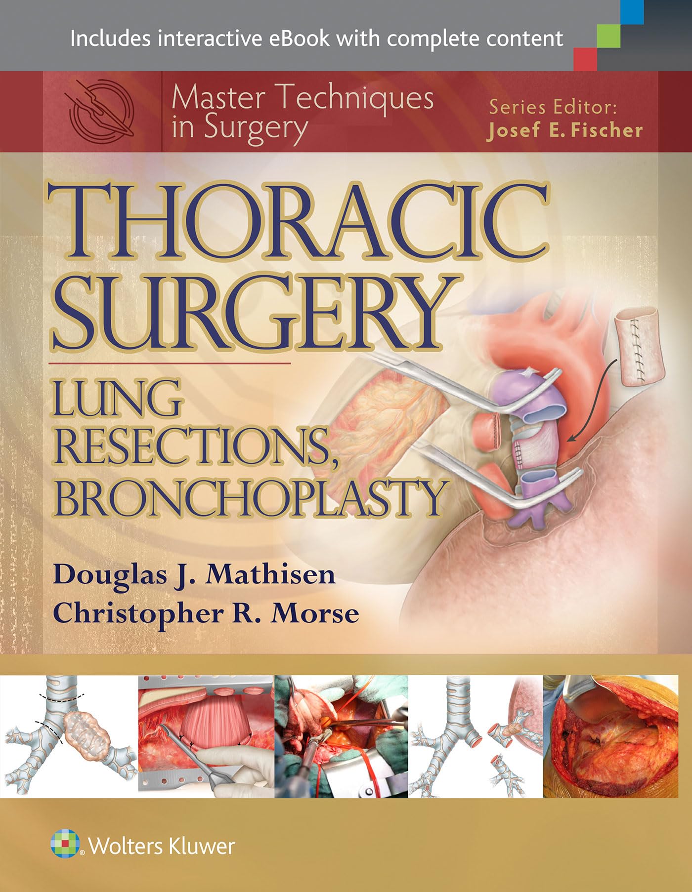 Master Techniques In Surgery Thoracic Surgery Lung Resections Bronchoplasty (Hb 2015)