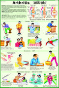 Arthritis Chart