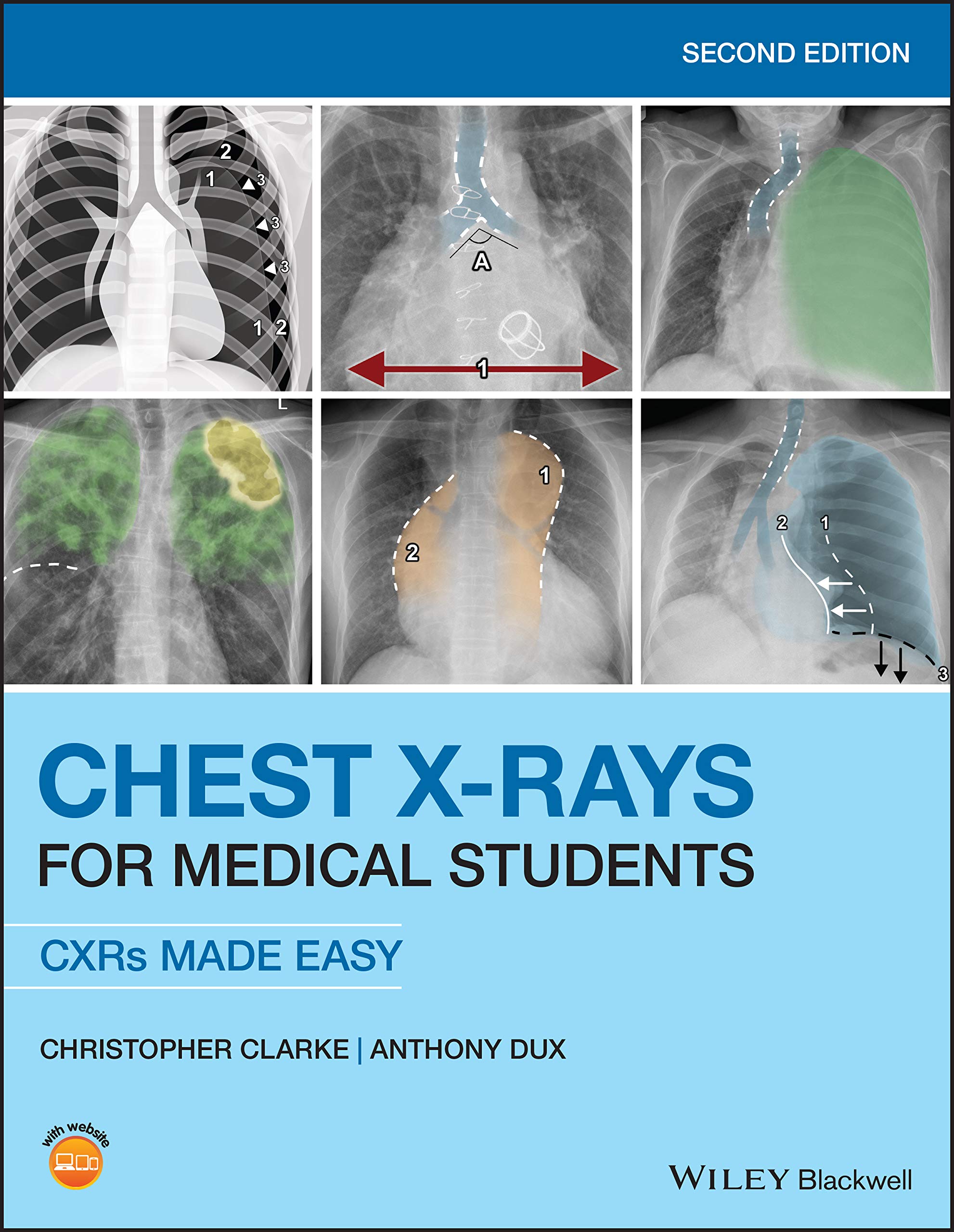 Chest XRays for Medical Students: CXRs Made Easy