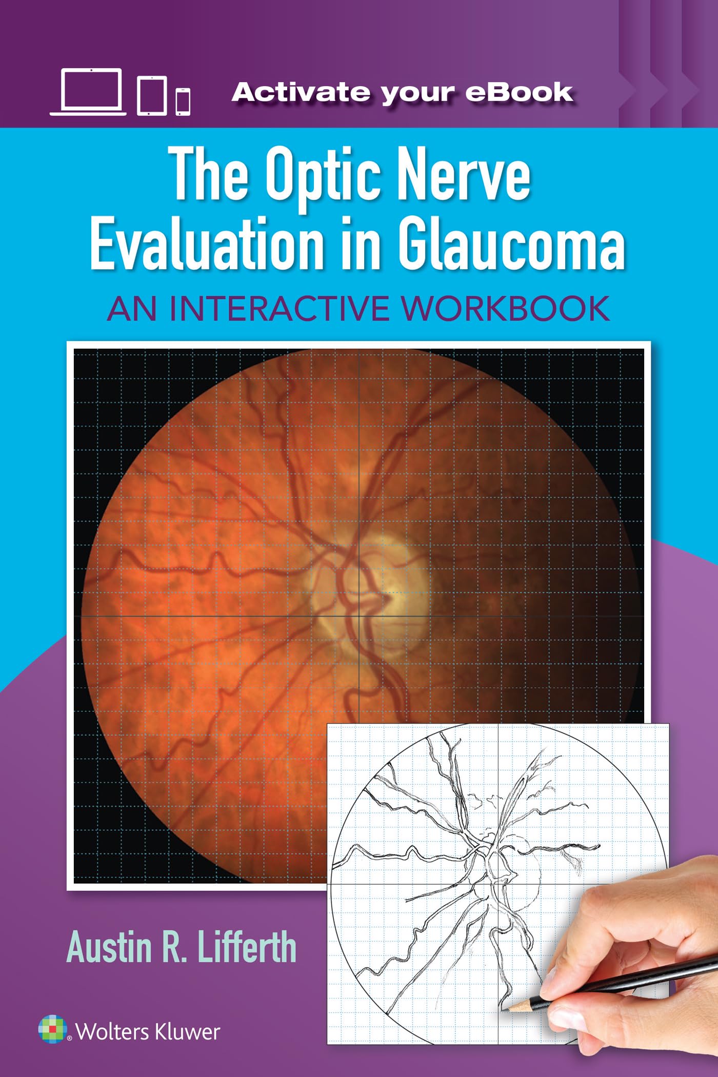 THE OPTIC NERVE EVALUATION IN GLAUCOMA AN INTERACTIVE WORKBOOK (PB 2017)