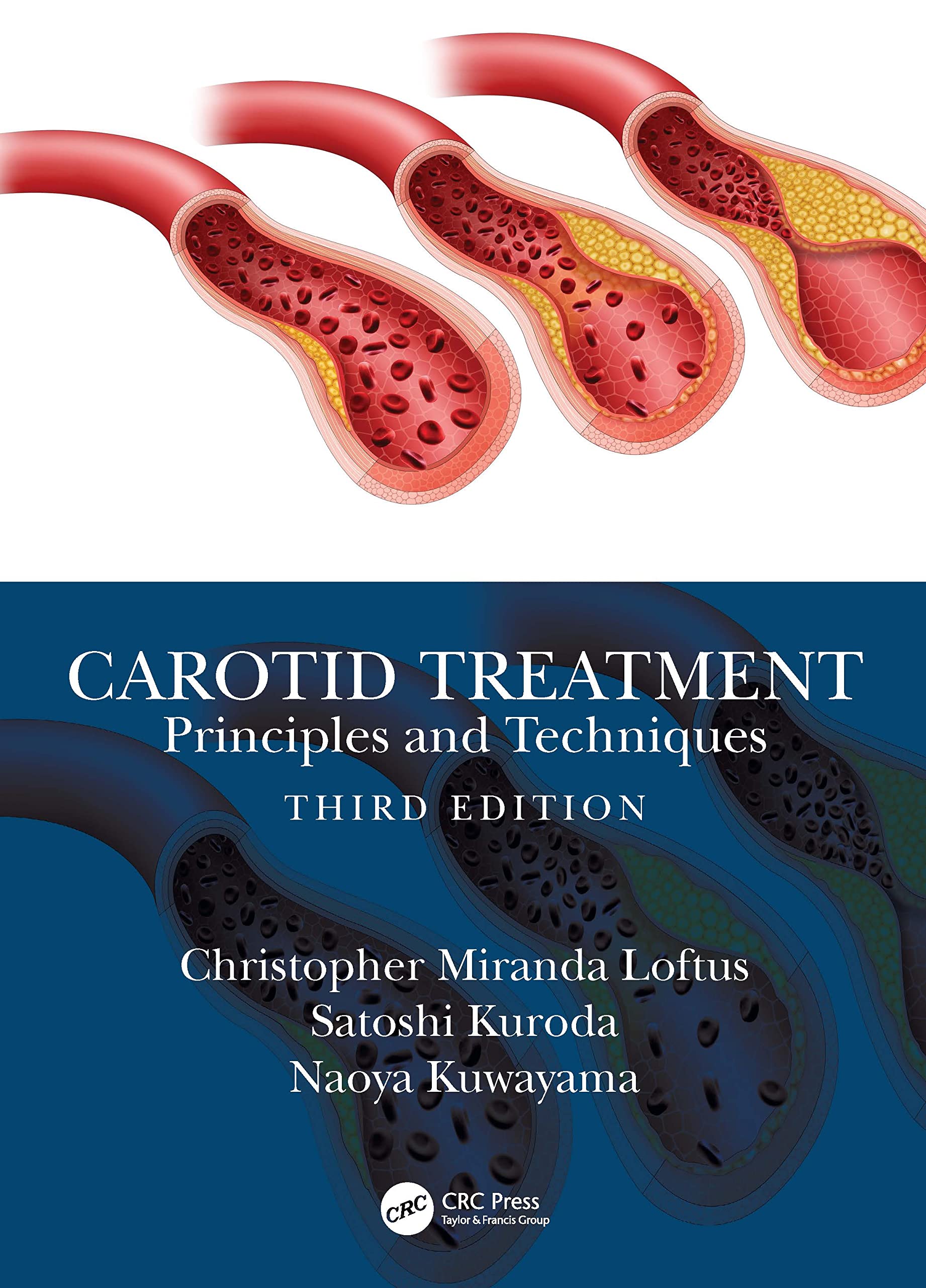 CAROTID TREATMENT PRINCIPLES AND TECHNIQUES 3ED (HB 2022)