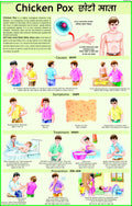 Chicken pox Chart
