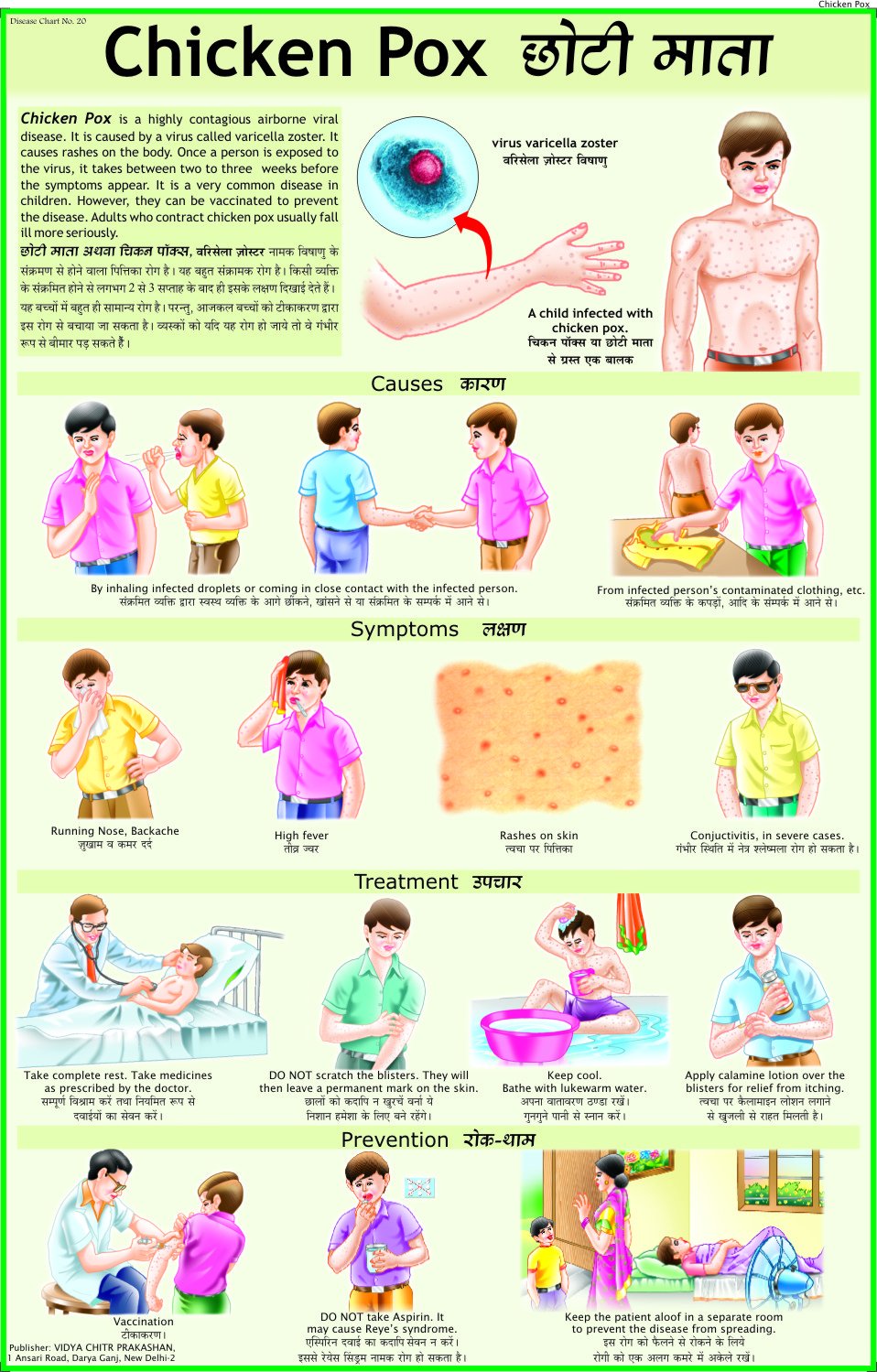 Chicken pox Chart