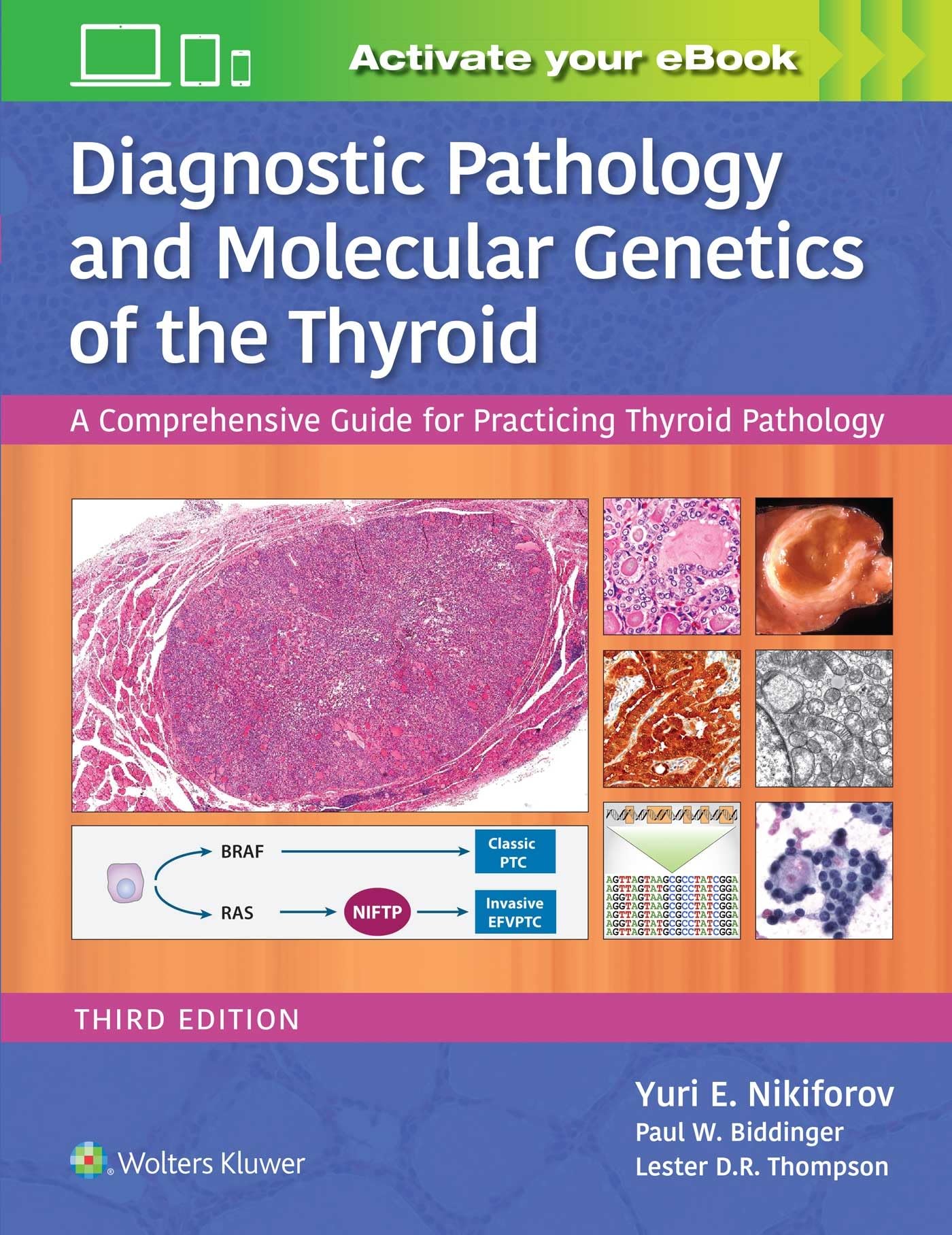 Diagnostic Pathology And Molecular Genetics Of The Thyroid A Comprehensive Guide For Practicing Thyroid Pathology 3Ed (Hb 2020)