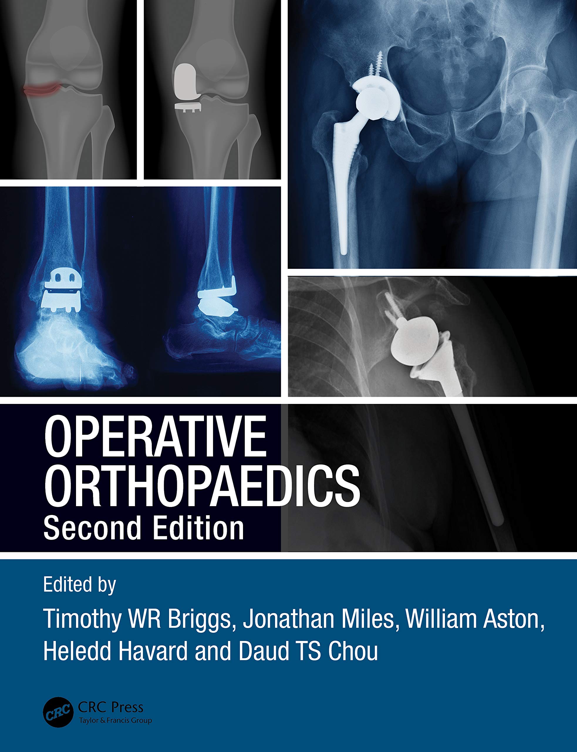 Operative Orthopaedics 2Ed (Pb 2021): The Stanmore Guide