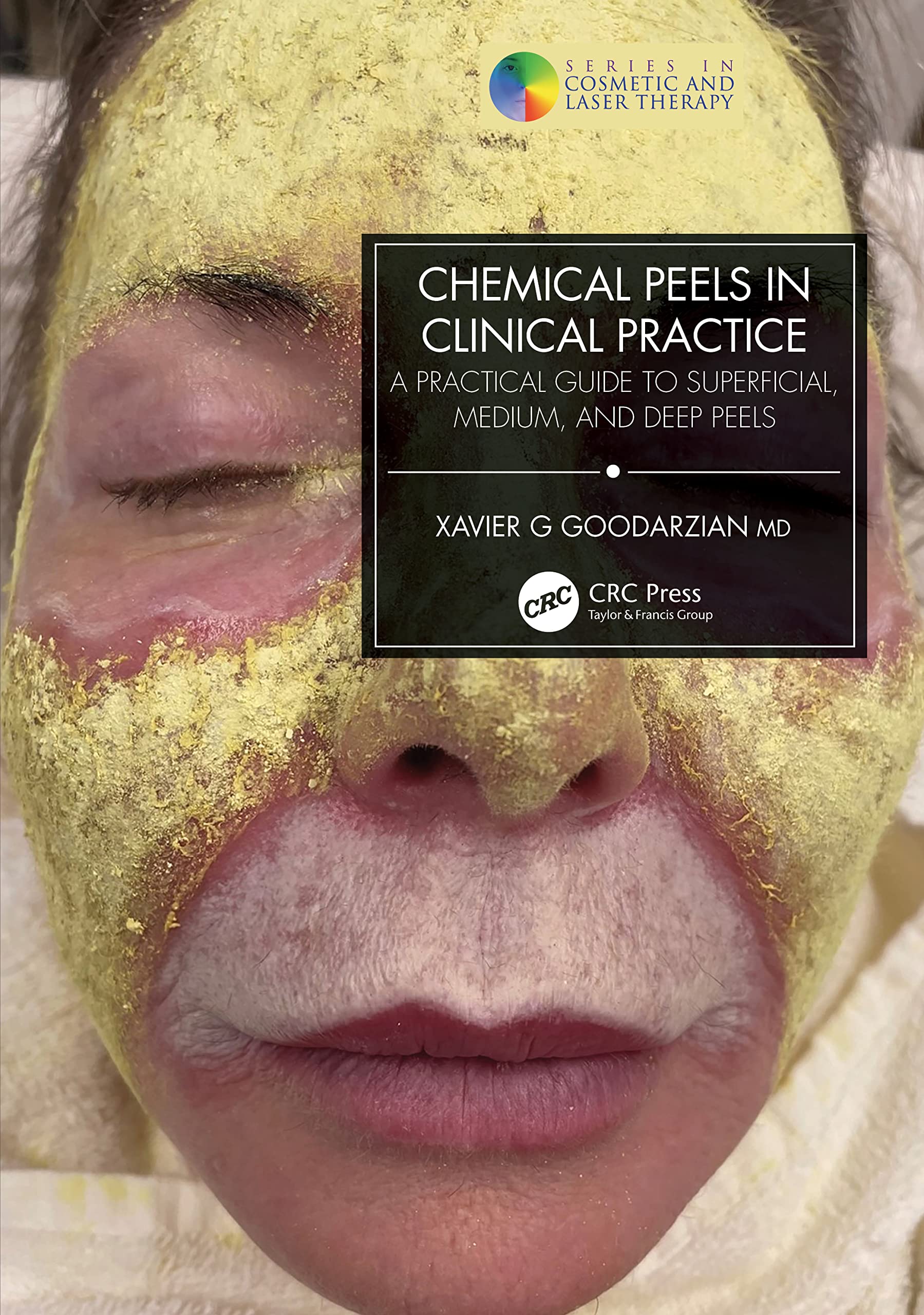 Chemical Peels In Clinical Practice: A Practical Guide To Superficial, Medium, And Deep Peels (Series In Cosmetic And Laser Ther
