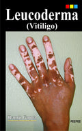 Leucoderma (Vitiligo)