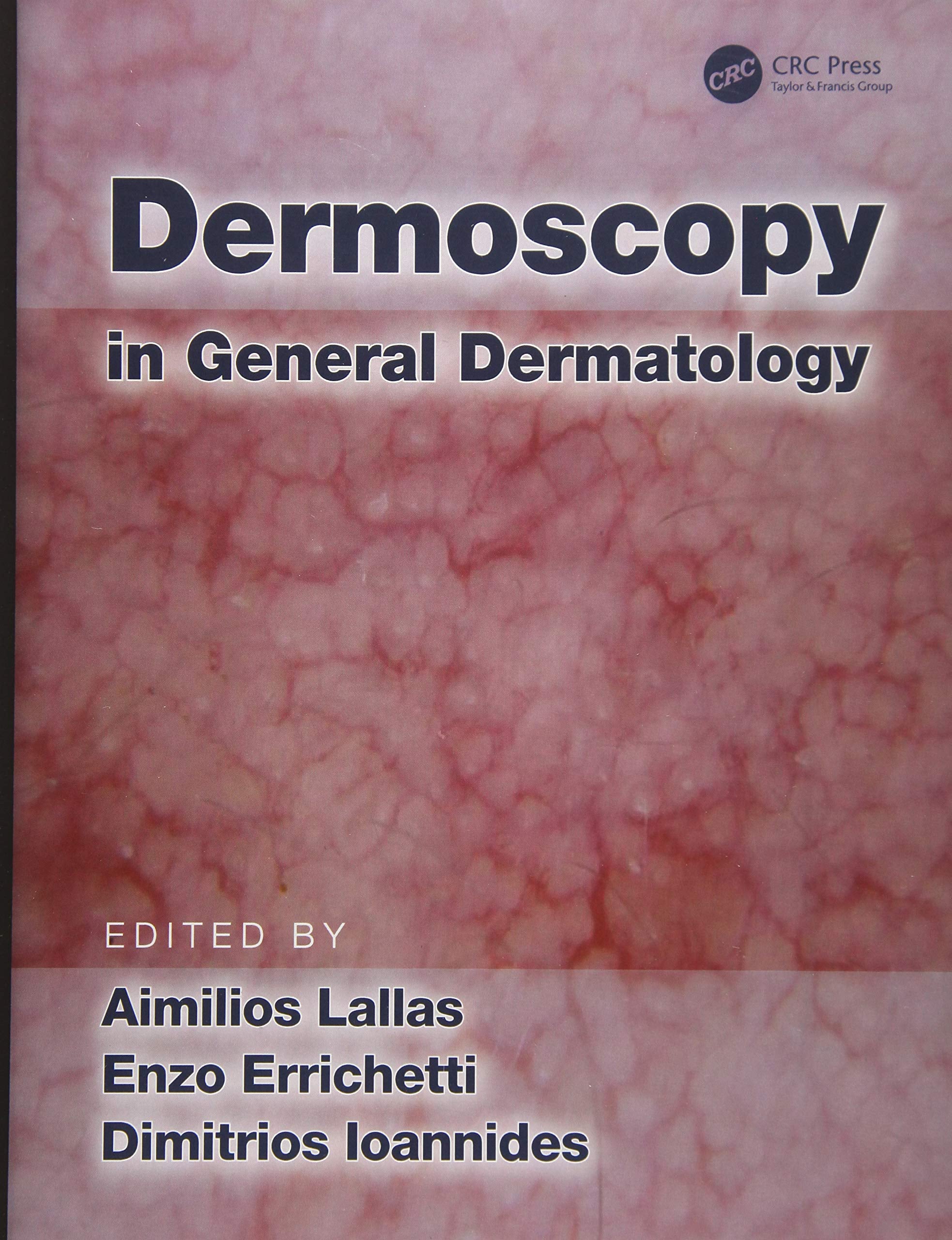 Dermoscopy In General Dermatology